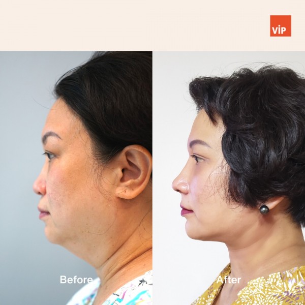 Nose Surgery, Face Lift - Deep Plane Facelift, Neck lift, & Asian Rib Cartilage Rhinoplasty, Mid Face Augmentation