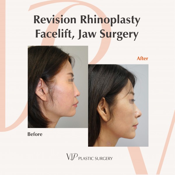 Nose Surgery, Facial Bone Surgery, Face Lift - Revision Rhinoplasty, Facelift, Jaw Surgery