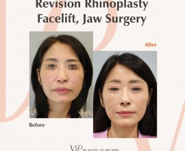Revision Rhinoplasty, Facelift, Jaw Surgery