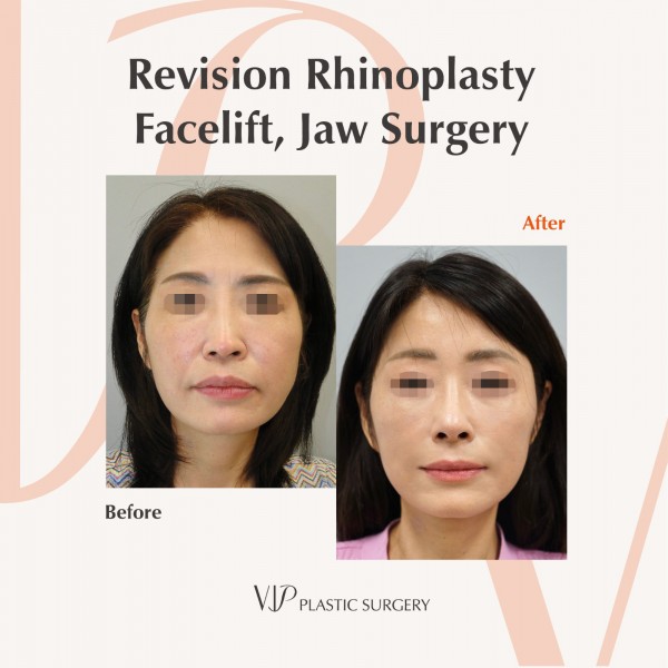 Nose Surgery, Facial Bone Surgery, Face Lift - Revision Rhinoplasty, Facelift, Jaw Surgery