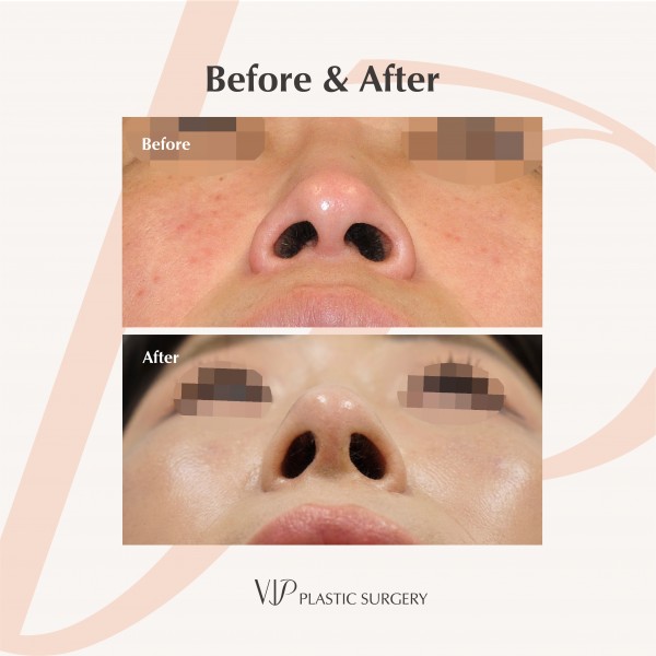 Nose Surgery, Facial Bone Surgery, Face Lift - Revision Rhinoplasty, Facelift, Jaw Surgery