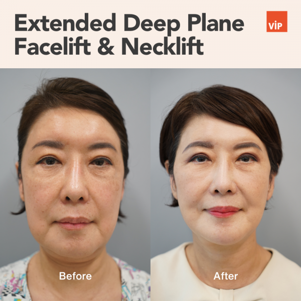 Face Lift - Extended Deep Plane Facelift & Necklift