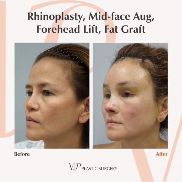 Nose Surgery, Stem Cell Fat Graft - Rib cartilage rhinoplasty, Mid-face augmentation, Forehead lift, Fat graft