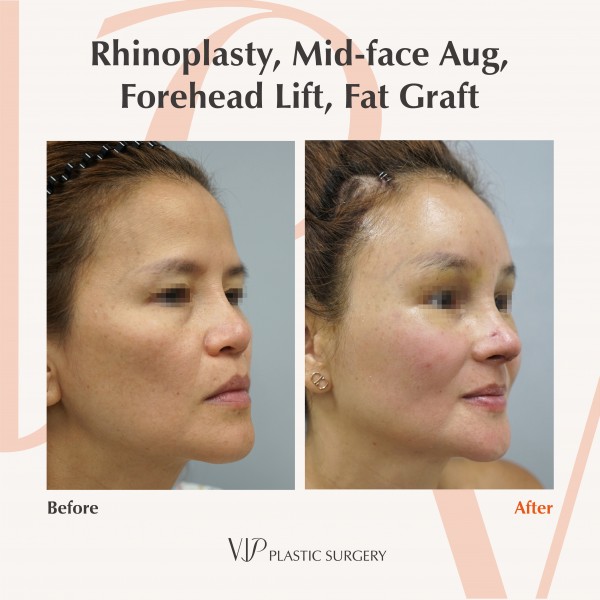 Nose Surgery, Stem Cell Fat Graft - Rib cartilage rhinoplasty, Mid-face augmentation, Forehead lift, Fat graft