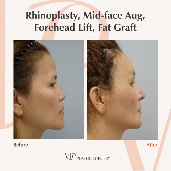 Nose Surgery, Stem Cell Fat Graft - Rib cartilage rhinoplasty, Mid-face augmentation, Forehead lift, Fat graft