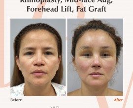Rib cartilage rhinoplasty, Mid-face augmentation, Forehead l…