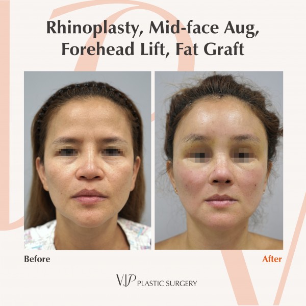Nose Surgery, Stem Cell Fat Graft - Rib cartilage rhinoplasty, Mid-face augmentation, Forehead lift, Fat graft