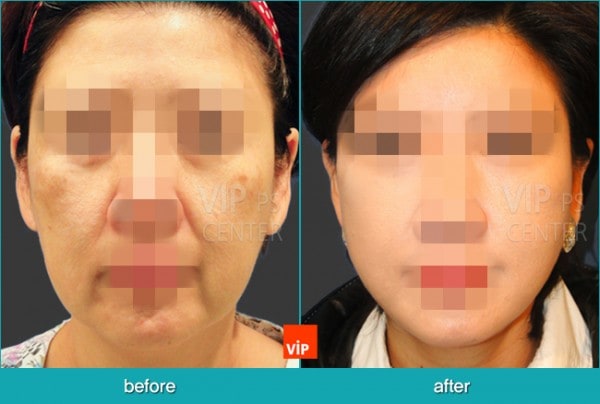 	Face Lift	 - High SMAS Face / Neck Lift with Dermis graft