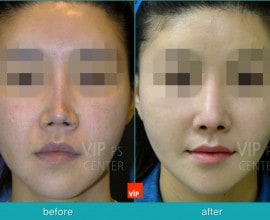 Rib Cartilage Rhinoplasty