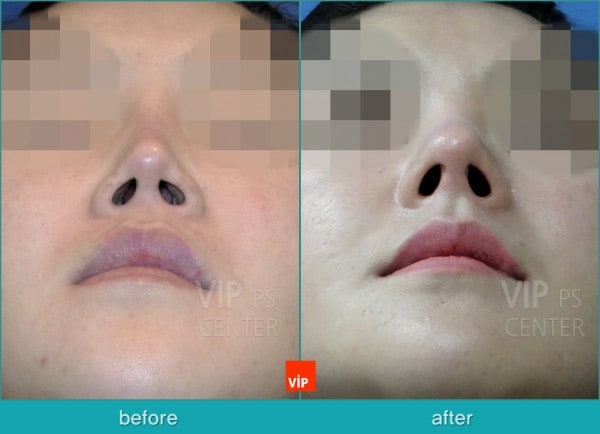 	Nose Surgery, Harmony-Rhinoplasty, Rib cartilage Rhinoplasty, Contracted Nose, Revision Rhinoplasty	 - Rib Cartilage Rhinoplasty