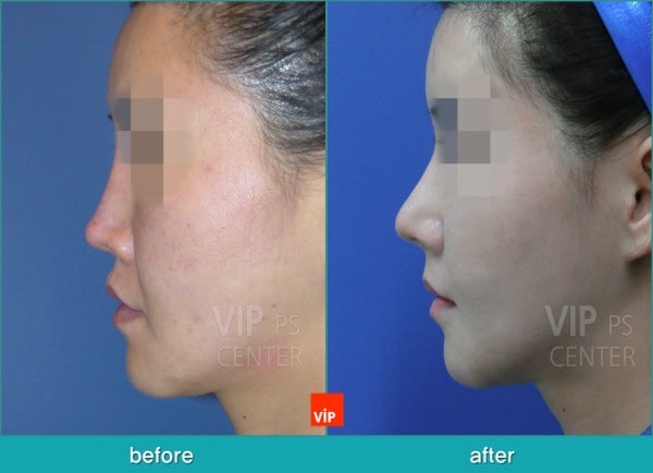 	Nose Surgery, Harmony-Rhinoplasty, Rib cartilage Rhinoplasty, Contracted Nose, Revision Rhinoplasty	 - Rib Cartilage Rhinoplasty