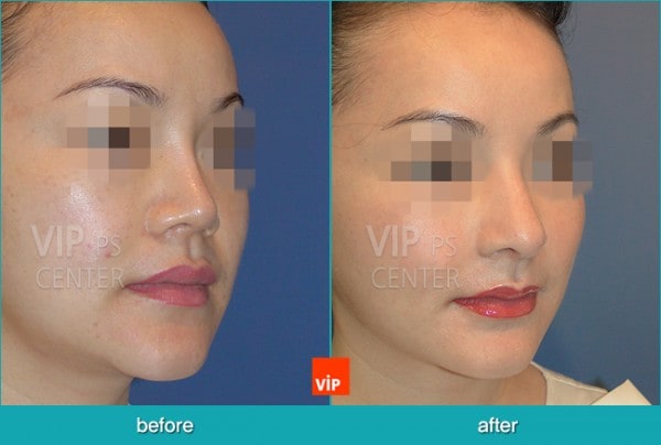 	Nose Surgery, Rib cartilage Rhinoplasty, Contracted Nose, Revision Rhinoplasty, Septal Deviation	 - Short nose Revision with Rib cartilage rhinoplasty