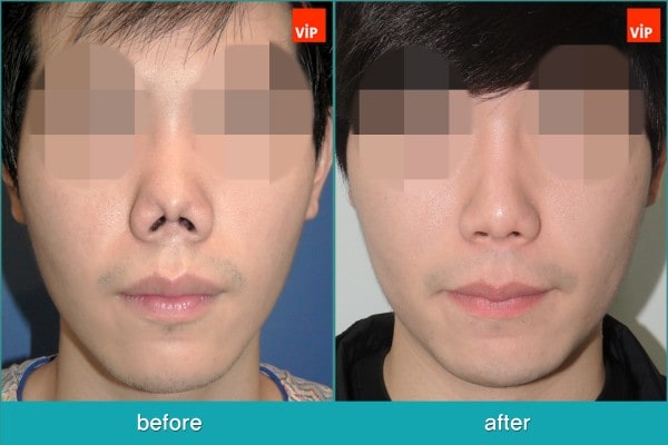 	Nose Surgery, Rib cartilage Rhinoplasty, Contracted Nose, Revision Rhinoplasty, Each Cases Nose	 - Revision rhinoplasty