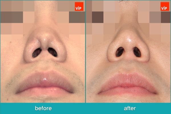 	Nose Surgery, Rib cartilage Rhinoplasty, Contracted Nose, Revision Rhinoplasty, Each Cases Nose	 - Revision rhinoplasty