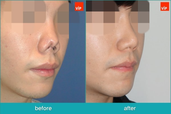 	Nose Surgery, Rib cartilage Rhinoplasty, Contracted Nose, Revision Rhinoplasty, Each Cases Nose	 - Revision rhinoplasty