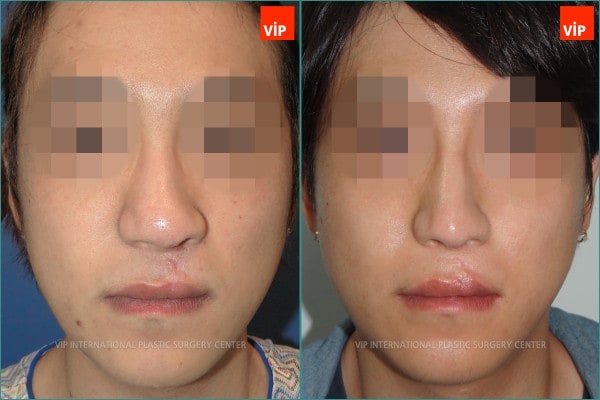 	Nose Surgery, Each Cases Nose	 - cleft lip nose surgery