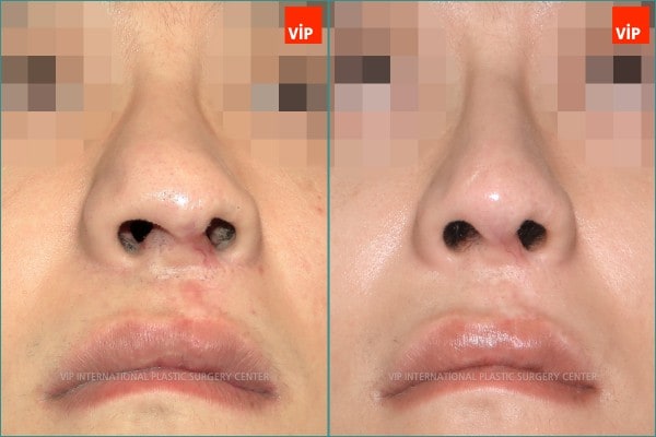 	Nose Surgery, Each Cases Nose	 - cleft lip nose surgery