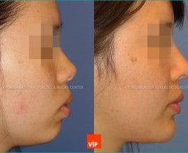 Protruded Mouth Correction by Rhinoplasty