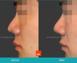 Cleft Nose Deformity Correction