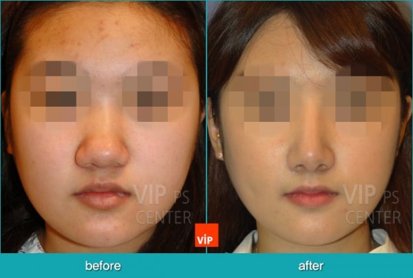 	Nose Surgery, Harmony-Rhinoplasty, Contracted Nose, Each Cases Nose	 - Bulbous nose - Harmony Rhinoplasty