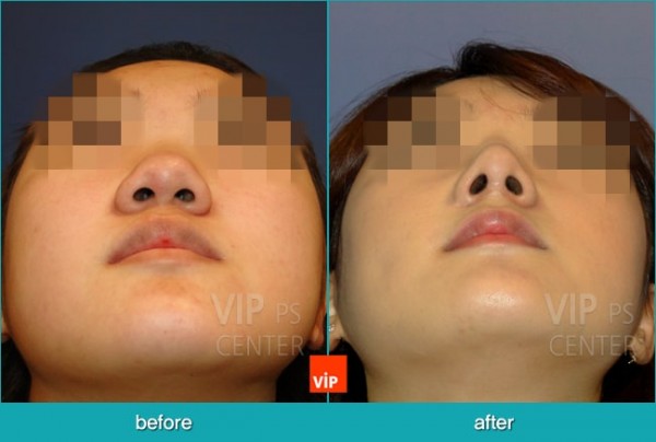 	Nose Surgery, Harmony-Rhinoplasty, Contracted Nose, Each Cases Nose	 - Bulbous nose - Harmony Rhinoplasty