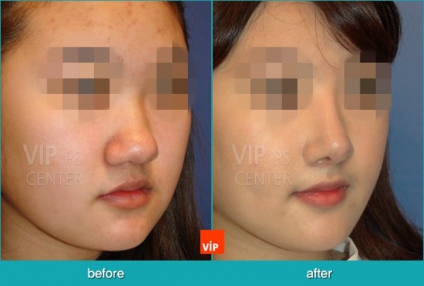 	Nose Surgery, Harmony-Rhinoplasty, Contracted Nose, Each Cases Nose	 - Bulbous nose - Harmony Rhinoplasty