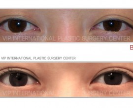 Non-incision double eyelid