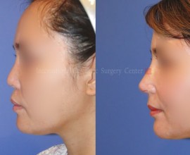 VIP Harmony face with Rib cartilage