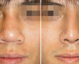 Male rhinoplasty