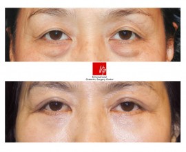 Lower eyelid blepharoplasty