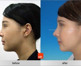 Harmony face rhinoplasty considering balance between forehea…