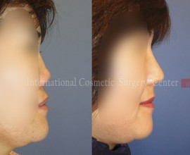 Collapsed nose due to side effects from foreign implant - Re…