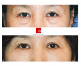 Lower eyelid blepharoplasty (eye bag removal)