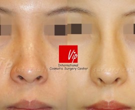 Harmony rhinoplasty with Rib cartilage