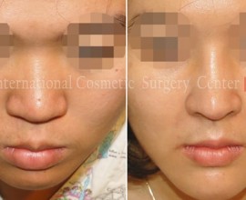 Flat nose correction