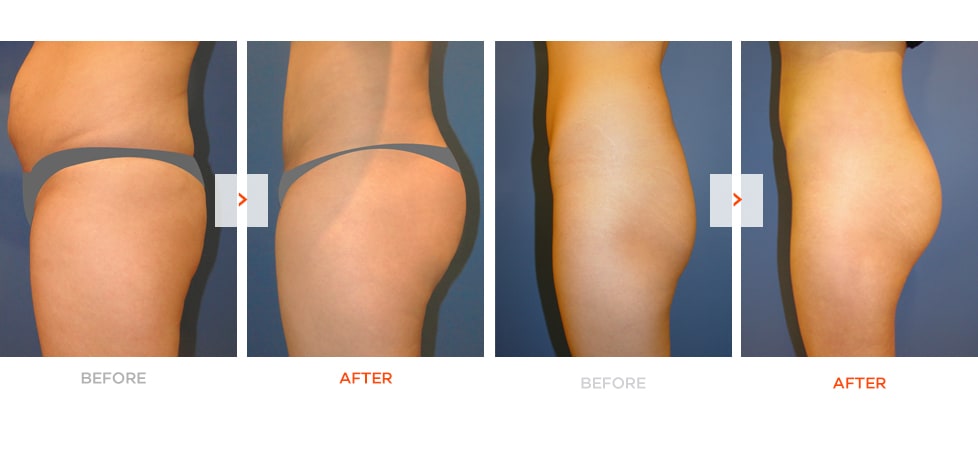 Apple Hip-up Surgery Before and After
