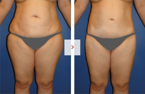 Liposuction Before and After