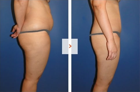 Liposuction Before and After