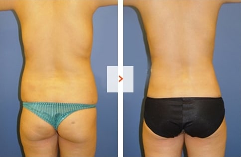 Liposuction Before and After