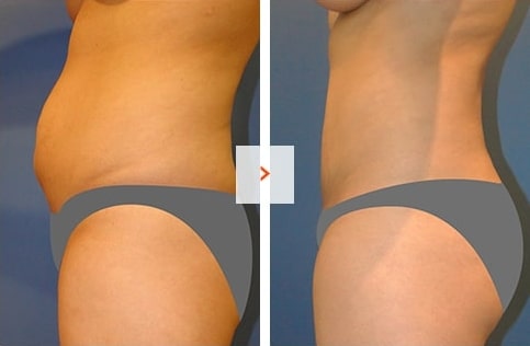 Liposuction Before and After