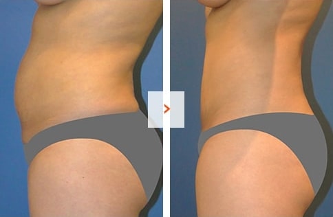 Liposuction Before and After