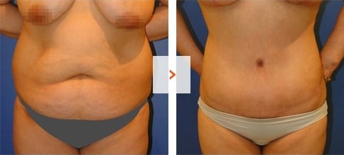 Liposuction Before and After