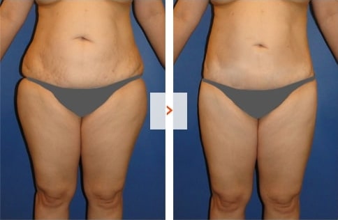 Tummy-Tuck Before and After