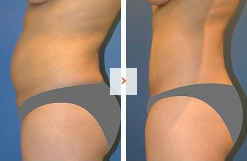 Tummy-Tuck Before and After