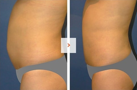 Tummy-Tuck Before and After