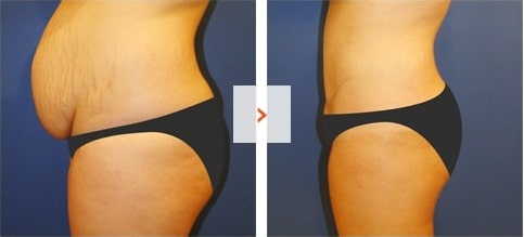 Tummy-Tuck Before and After
