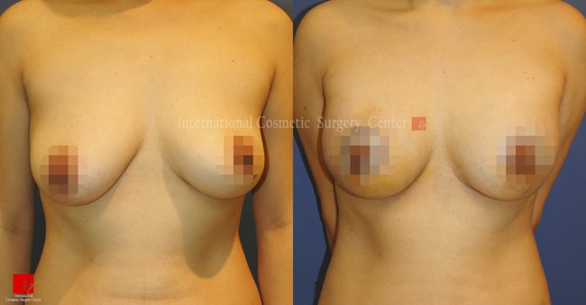 Breast Augmentation and Breast Lift Before and After