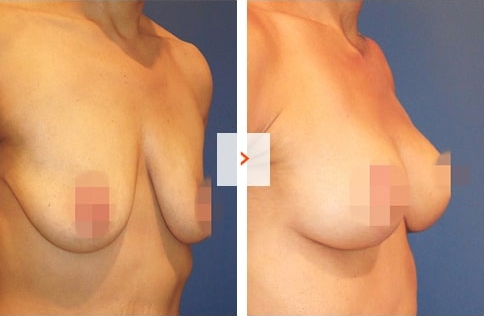 Breast Lift Surgery Before and After