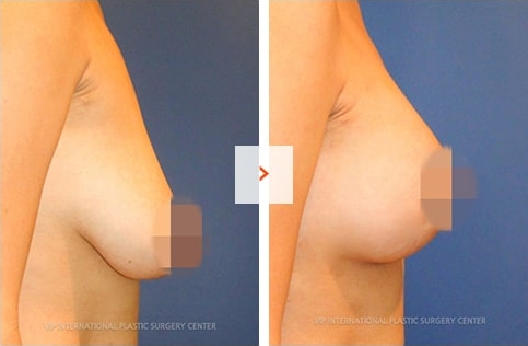 Breast Lift Surgery Before and After