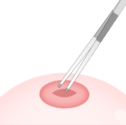 Steps for Purse-String Suture Method